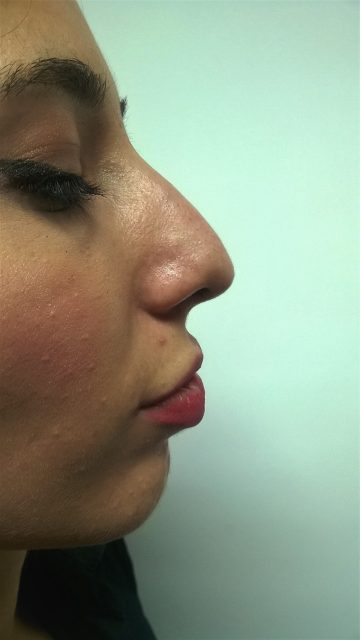 Korekcija nosa bez operacije B1